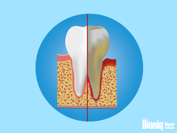 Periodontitis and bacterial inflammation of the tooth socket