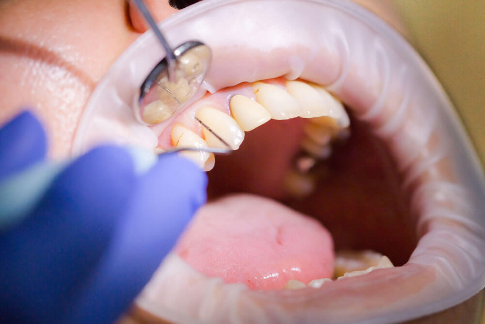 Periodontitis – treatment by a dentist