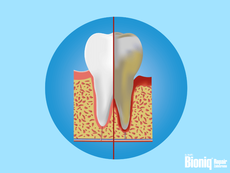 Illustration eines Backenzahns mit Wurzel: links gesunder Zahn und Zahnfleisch, rechts Zahn mit Plaque-Ablagerungen und entzündetem Zahnfleisch